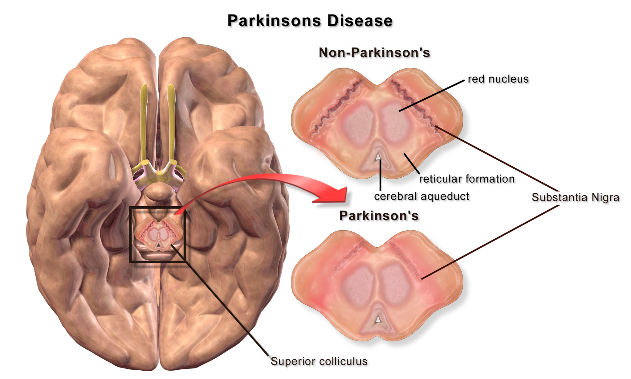 Can CBD Oil Be Used For Treating Parkinson’s Disease?